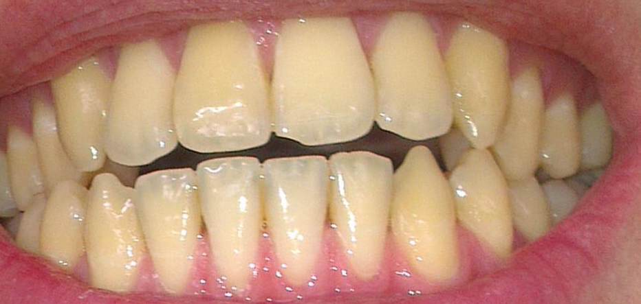 nguyên nhân gây ra răng vàng