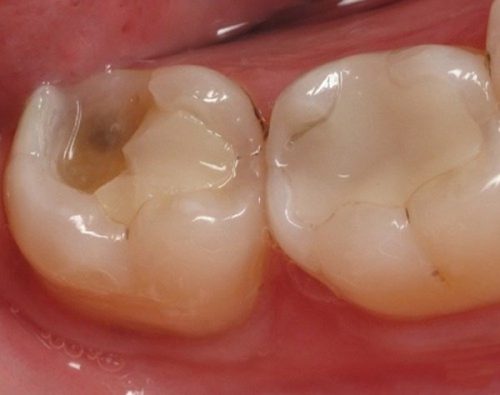 răng sâu bị nhức, rang sau bi nhuc, răng sâu bị nhức phải làm sao, rang sau bi nhuc phai lam sao