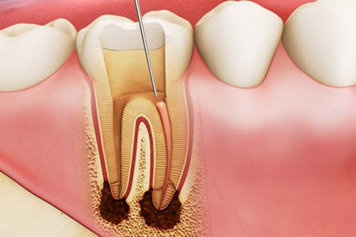 răng sâu bị nhức, rang sau bi nhuc, răng sâu bị nhức phải làm sao, rang sau bi nhuc phai lam sao