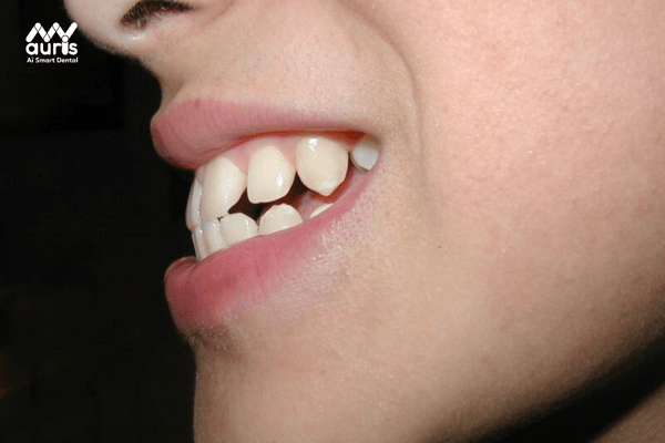 bọc răng sứ 2 răng cửa bị hô