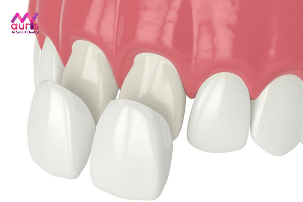 Bọc răng sứ răng cửa là gì?