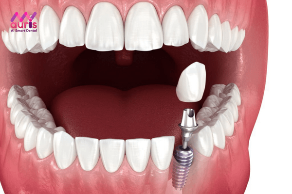 Thực hiện trồng răng sứ vĩnh viễn bằng phương pháp nào tốt nhất?