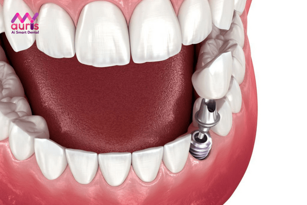 Giá làm răng sứ vinh viễn bằng trồng răng Implant