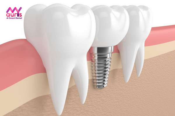 Làm bộ răng bằng trồng răng Implant