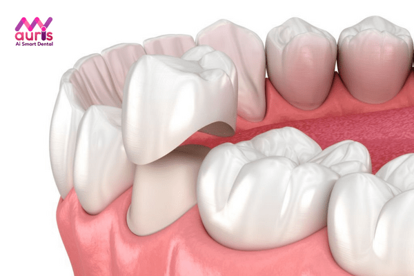 Phương pháp bọc răng sứ thẩm mỹ được hiểu như thế nào?