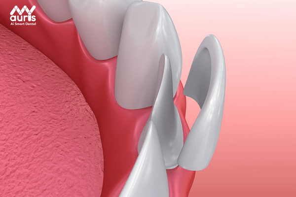 Bọc sứ lên trực tiếp vùng răng bị tổn thương