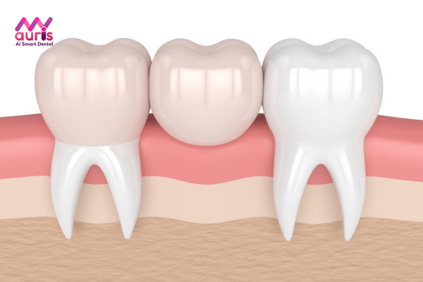 Làm cầu răng sứ có ảnh hưởng xương hàm không?