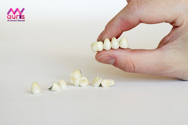 Răng sứ kim loại có thể gây đen viền nướu, hở cổ chân răng