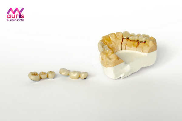 Làm thế nào để tránh các tác hại của răng sứ kim loại mang đến?